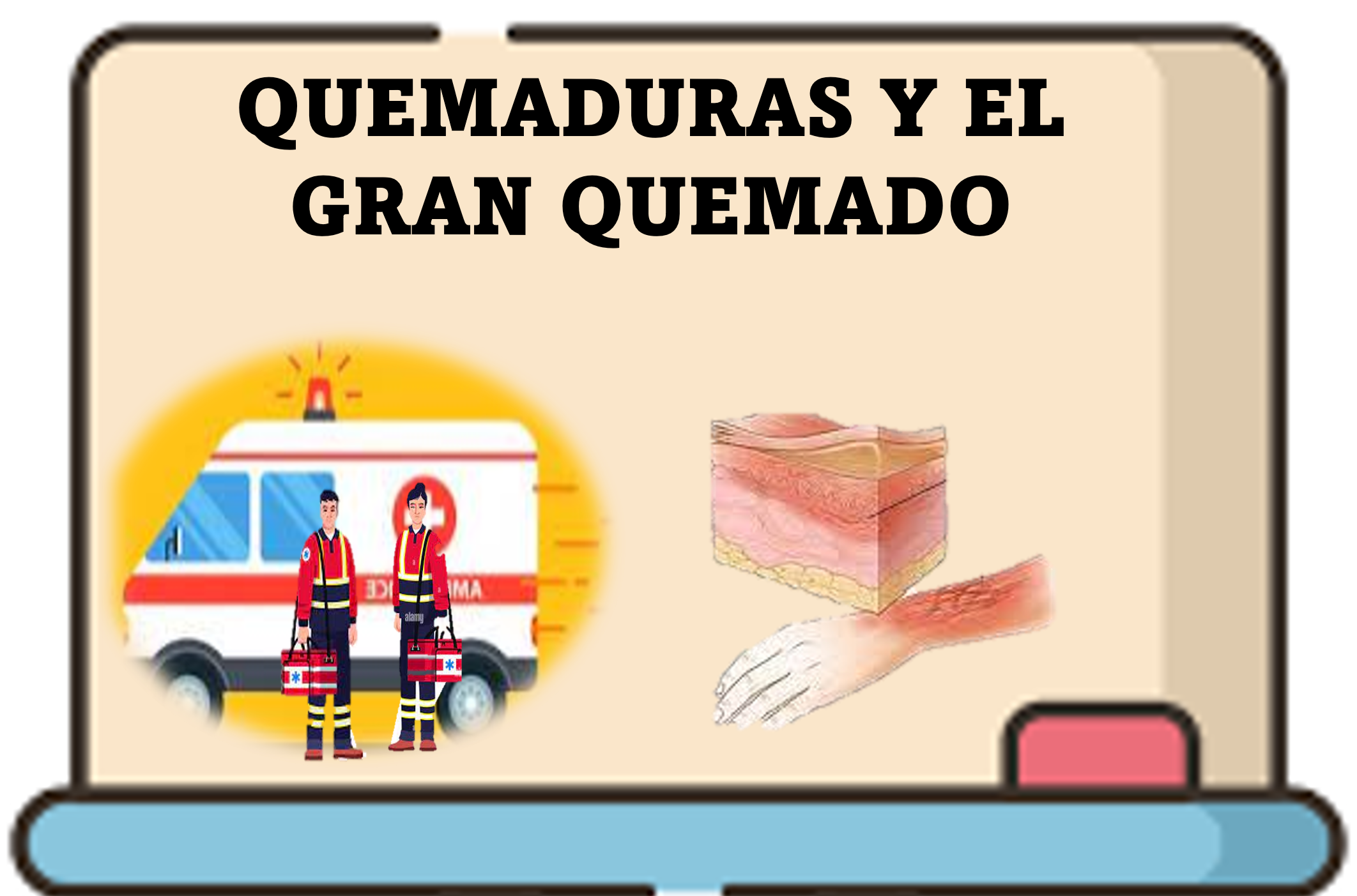 APH2023_QUE-QUEMADURAS Y EL GRAN QUEMADO